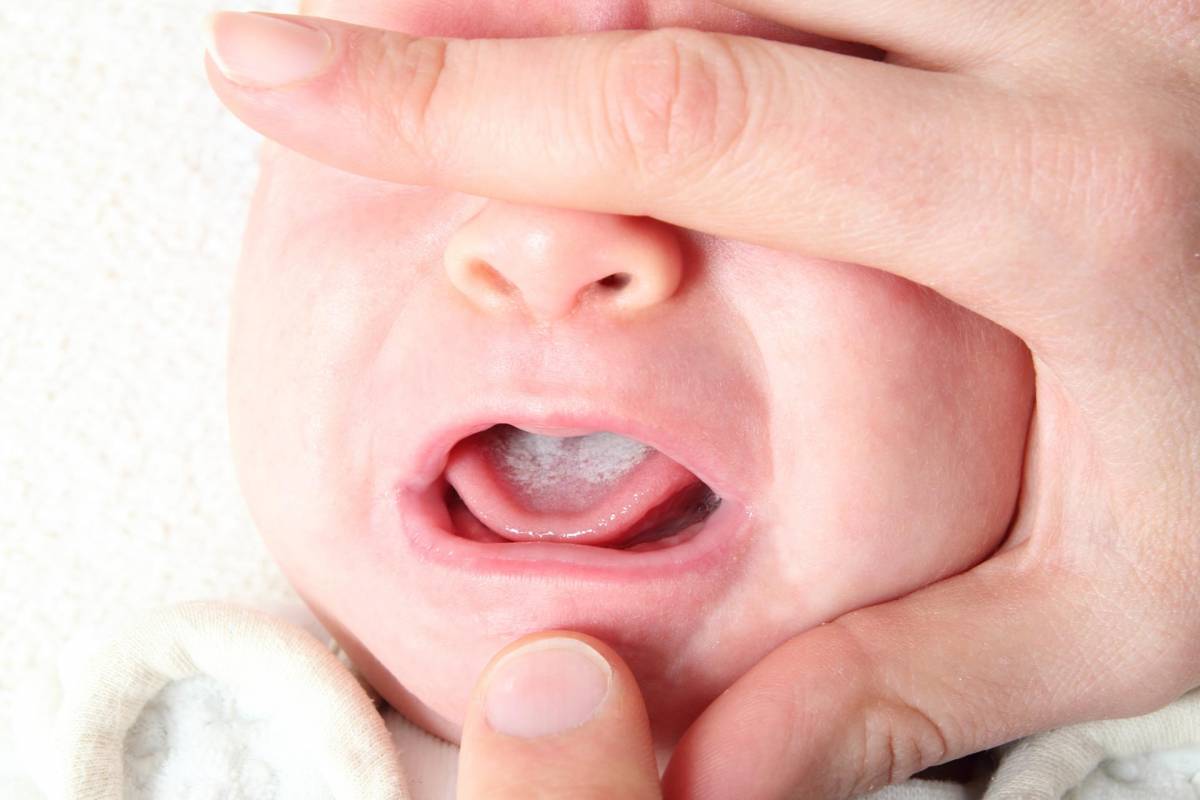 Mlečac (soor) se vidi na jeziku bebe