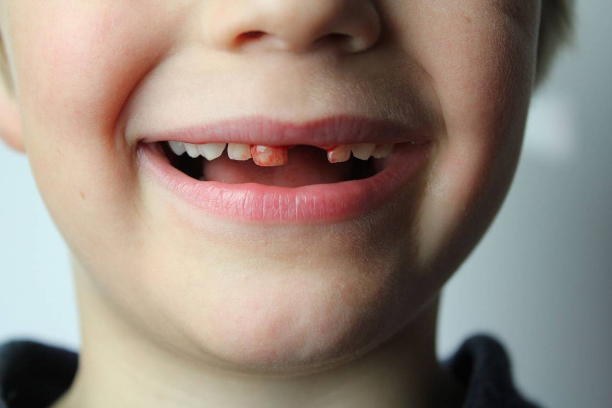 Bleeding from a wound from an extracted tooth