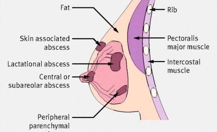 medical diagram of mastitis and breast abscess