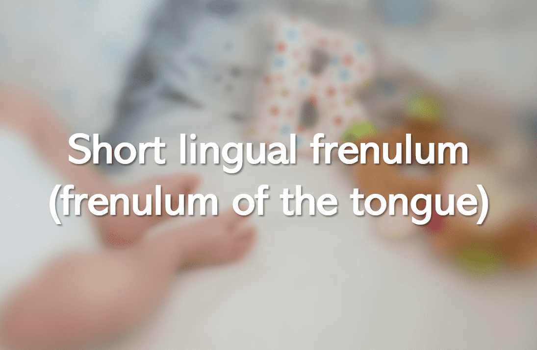 Short lingual frenulum (frenulum of the tongue)