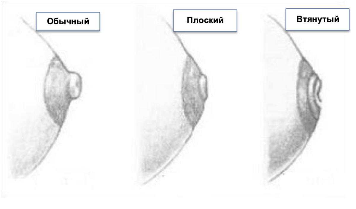 Плоские или втянутые соски