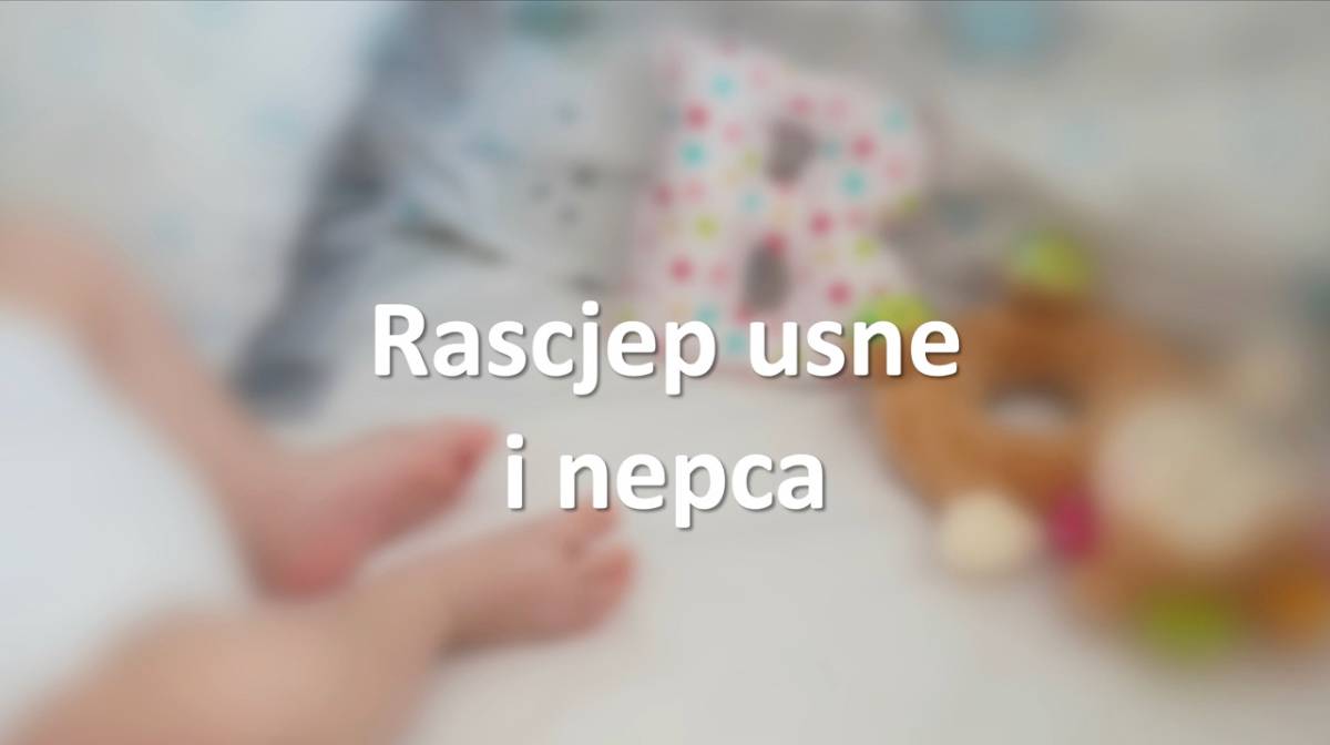Rascjep usne i nepca