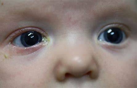 Blocked tear duct