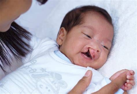 Child with cleft palate