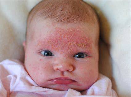 Cradle cap