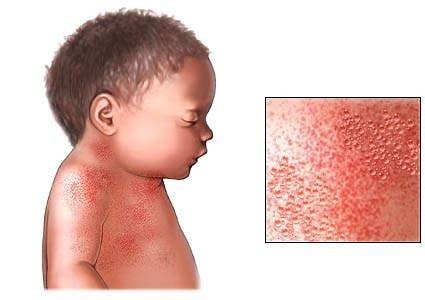 Heat rash