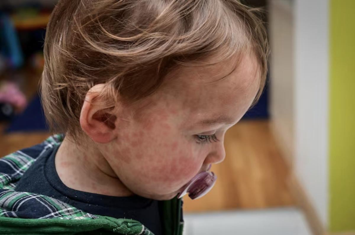 Measles
