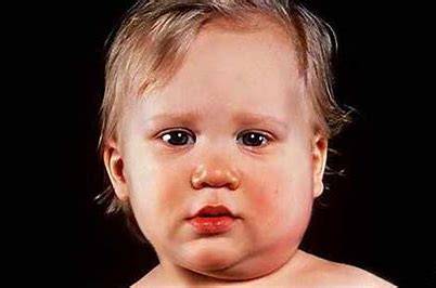 Mumps