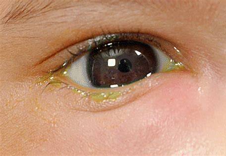 Neonatal conjunctivitis