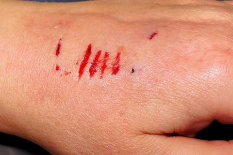 An arm with dog bite wounds