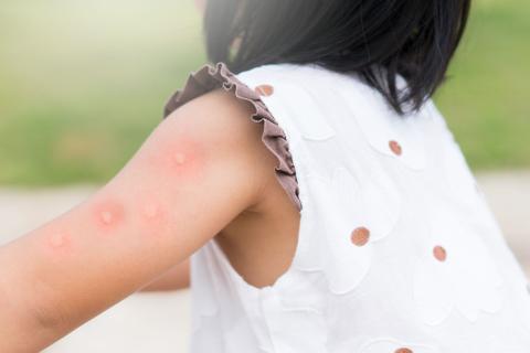 Mosquito bites on a child's upper arm