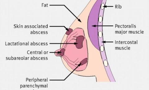 medical diagram of mastitis and breast abscess
