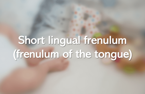 Short lingual frenulum (frenulum of the tongue)