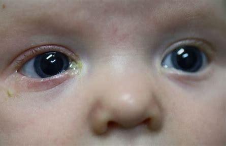 Blocked tear duct