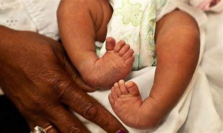 Clubbed feet