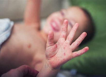 HFM disease