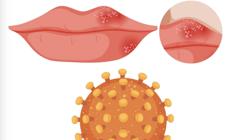 Herpes simplex virus
