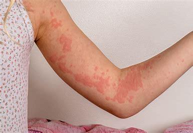 Hives