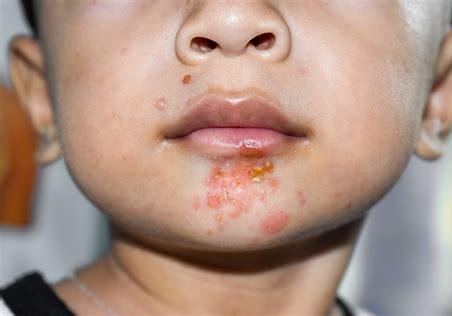 Impetigo