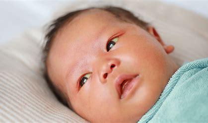 Baby with jaundice