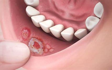 Mouth ulcers