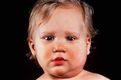 Mumps