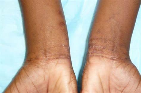 Scabies