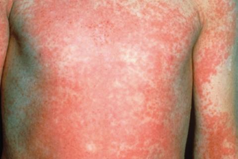 Scarlet fever rash