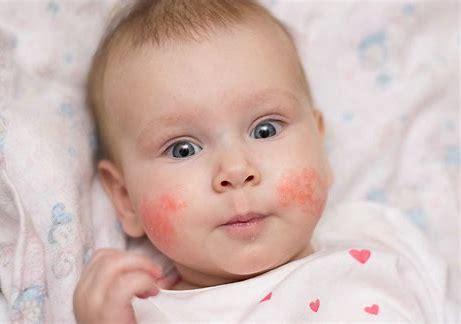 Slapped cheek disease