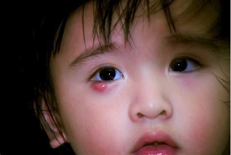 Stye