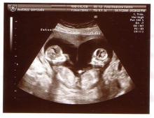 Twin ultrasound scan